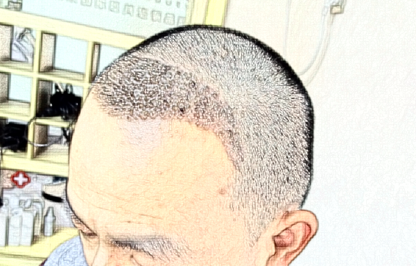 大連發(fā)際線種植費用要多少?大連發(fā)際線種植醫(yī)院推薦