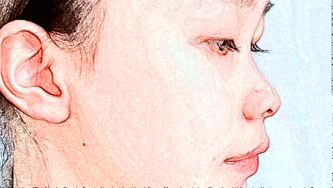 鼻翼縮小價格表_鼻翼縮小術(shù)后還會反彈嗎