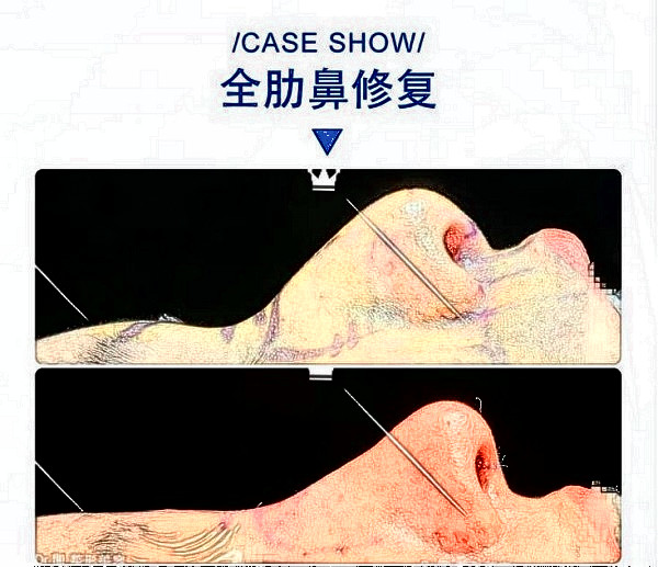 華西醫(yī)院卿勇全肋鼻修復案例圖片（來源知乎）