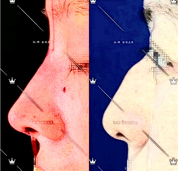 華西醫(yī)院卿勇駝峰鼻矯正案例圖片（來源知乎）