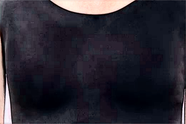 去副乳價(jià)目表公布_去副乳會(huì)留疤嗎