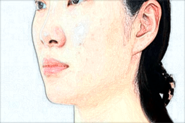 耳垂矯正價(jià)格表_垂耳矯正后還會(huì)垂下來(lái)嗎