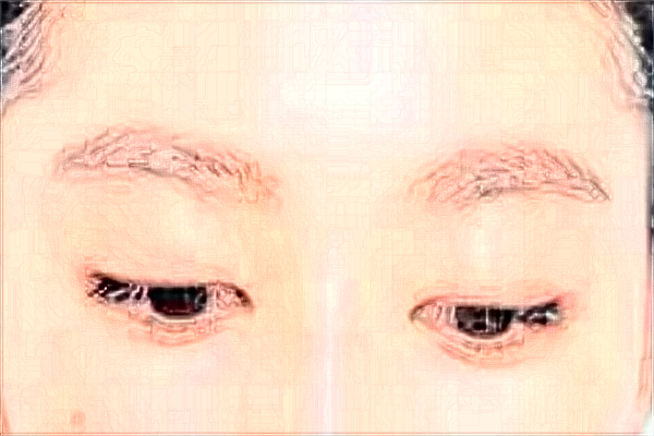 割雙眼皮會留疤痕不?割雙眼皮會導(dǎo)致視力下降嗎?