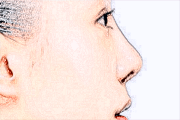 2024鄭大一附院玻尿酸收費怎么樣