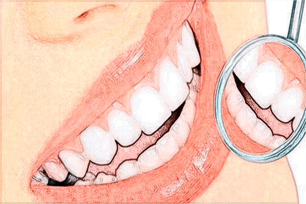 2024沈陽二院補牙價目表_補牙后需要做牙套嗎