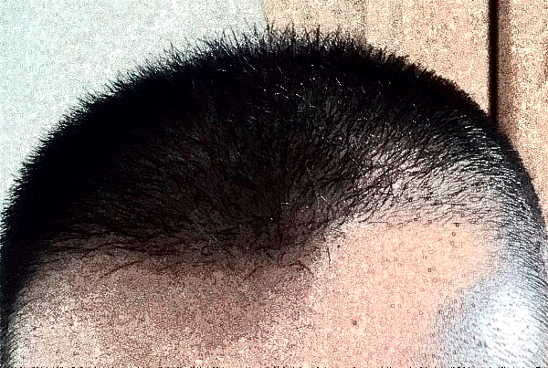 北京中醫(yī)醫(yī)院植發(fā)價(jià)目表(價(jià)格表)曝光_怎么樣