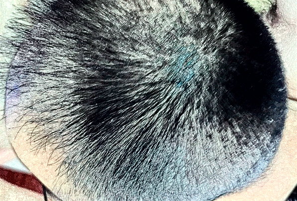 北京中醫(yī)醫(yī)院植發(fā)價(jià)目表(價(jià)格表)曝光_怎么樣