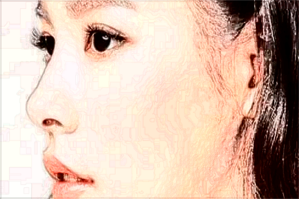 保定去眼袋哪家醫(yī)院好【去眼袋案例】