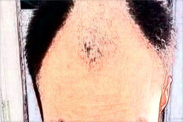 上海長(zhǎng)征醫(yī)院種發(fā)際線收費(fèi)價(jià)格_種發(fā)際線怎么樣