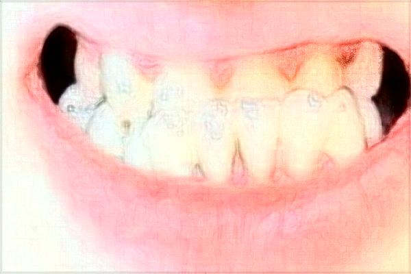 種植牙那種材質(zhì)好?(11月更新)聊城二院種植牙收費(fèi)2024