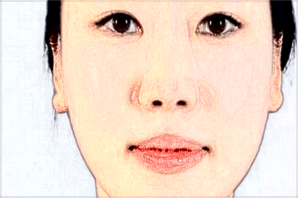 聊城二院鼻翼縮小價格2024_鼻翼縮小的方法有幾種