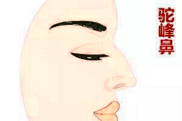 成都華西醫(yī)院隆鼻假體取出多少錢_隆鼻假體取出后多久可以恢復