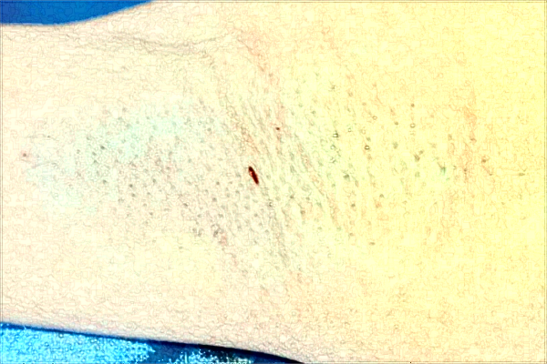 南京市中醫(yī)院激光狐臭做的好嗎？需要多少錢