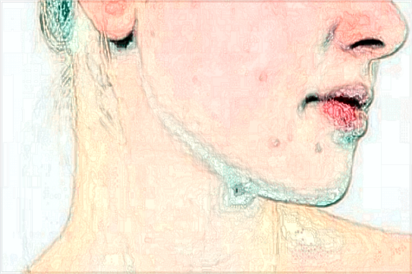 自體脂肪豐面頰多少錢?自體脂肪豐面頰多久可以做第二次?