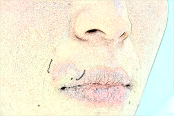 贛南醫(yī)學(xué)院第一附屬醫(yī)院祛痘印怎么樣?激光祛痘印價(jià)格2024