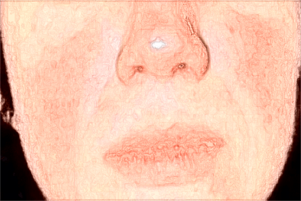 2024漳州175醫(yī)院光子嫩膚多少錢?光子嫩膚一般要做幾次