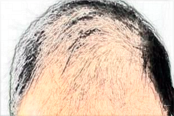 2024河科大二附院植發(fā)整形價格表公布