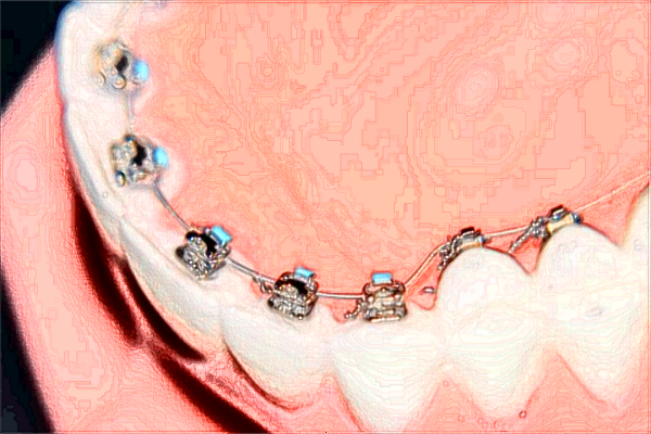 北大口腔醫(yī)院鑲滿口牙多少錢_鑲滿口牙需要把牙都拔掉嗎