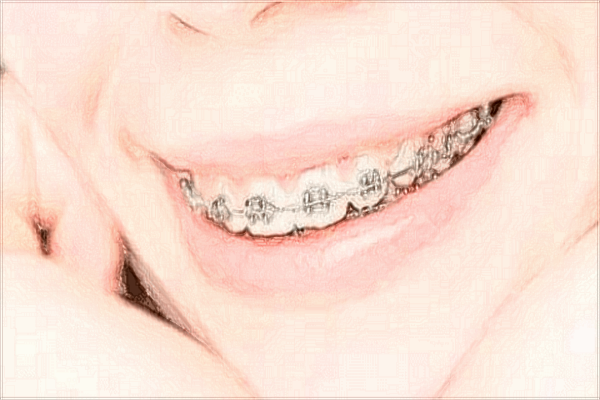 溫州醫(yī)學(xué)院附屬第一醫(yī)院牙齒矯正怎么樣_案例+價(jià)格