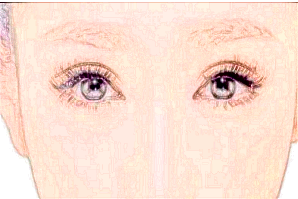 2024北大醫(yī)院去眼袋怎樣_哪個(gè)醫(yī)生做得好