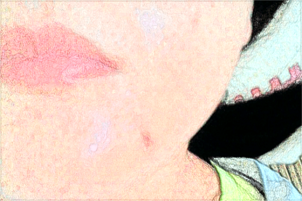 南昌大學第一附屬醫(yī)院祛痣掛什么科?2024祛痣價格