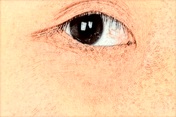 南昌大學第一附屬醫(yī)院祛痣掛什么科?2024祛痣價格