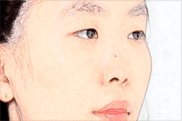 南昌大學(xué)第一附屬醫(yī)院去除胎記貴嗎?2024去除胎記的費用