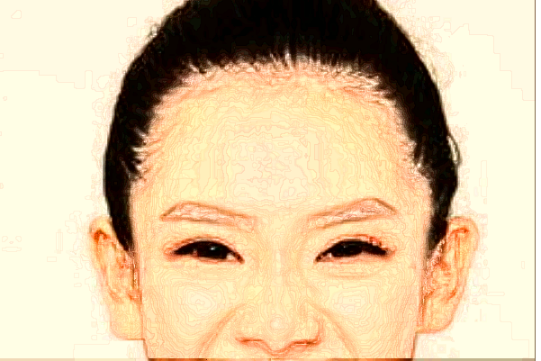 六安市人民醫(yī)院植發(fā)技術(shù)怎么樣【植發(fā)案例】