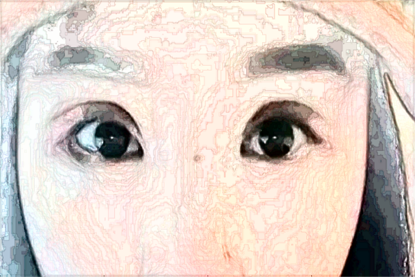 浙江省中醫(yī)院填淚溝做的好不好_填淚溝多長時間恢復好