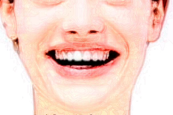 2024江蘇省口腔醫(yī)院瓷貼面怎么樣_案例+價格