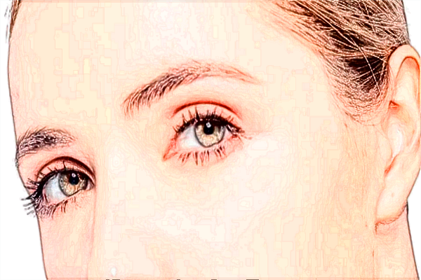 2024保定市第一中心醫(yī)院去眼袋多少錢(qián)_案例+價(jià)格分享