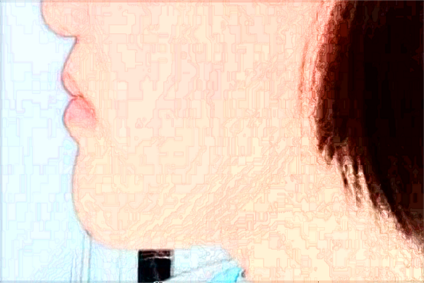 大連醫(yī)科大學(xué)附屬第一醫(yī)院熱瑪吉怎么樣_醫(yī)生技術(shù)好不好