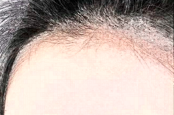 　　發(fā)際線不好看、大量脫發(fā)導(dǎo)致禿頂?shù)那闆r等，會給朋友們帶來很大的煩惱，這種情況可以選擇植發(fā)手術(shù)來，大連醫(yī)科大學(xué)附屬第一醫(yī)院做植發(fā)的技術(shù)比較不錯，根據(jù)大連地區(qū)網(wǎng)絡(luò)檢索的結(jié)果，比較常見的是發(fā)際線價格一般會在1100-38000元左右不等，比較常見的頭頂加密植發(fā)價格一般會在900-9300元左右不等，以上給出的價格僅供于參考，具體詳細(xì)的價格還需要到醫(yī)院找醫(yī)生進(jìn)行面診之后來獲取。  　　1、2024大連醫(yī)科大學(xué)附屬第一醫(yī)院植發(fā)案例  　　很多年前自己一直脫頭發(fā)，其實這也屬于正常的反應(yīng)，因為頭發(fā)都會有一個新陳代謝，隨著時間的增加，自己的頭發(fā)脫的有點多，每一次洗頭發(fā)的時候都掉一大把，當(dāng)時也沒有太在意，一次無意間發(fā)現(xiàn)了自己頭頂?shù)念^發(fā)有一些稀少，這才意識到了脫發(fā)的嚴(yán)重性，所以想通過植發(fā)手術(shù)來，在家人的陪同下來到了大連醫(yī)科大學(xué)附屬第一醫(yī)院，跟醫(yī)生說明了自己掉發(fā)的情況，并且問了醫(yī)生能不能做植發(fā)手術(shù)，醫(yī)生采取診斷之后建議說可以做植發(fā)手術(shù)，所以配合了醫(yī)生的工作，整體手術(shù)操作大概用了不到三個小時左右的時間，術(shù)后就能夠看到一些植發(fā)的痕跡，在半個月之后直的頭發(fā)慢慢的長了出來，看到長出來的頭發(fā)自己的心情也愉悅了很多，終于不用擔(dān)心頭發(fā)稀少的問題帶來的困擾了。  　　2、2024大連醫(yī)科大學(xué)附屬第一醫(yī)院簡介  　　大連醫(yī)科大學(xué)附屬第一醫(yī)院整形美容科是一個集醫(yī)療、教學(xué)、科研、預(yù)防為一體的大型綜合性醫(yī)院，醫(yī)院包括有美容外科、整形外科、頜面美容外科、皮膚激光美容外科等，醫(yī)院開展的手術(shù)項目有先天性和創(chuàng)傷性的畸形修復(fù)、除皺、乳房整形、減肥、面部年輕化抗衰老、植發(fā)、手術(shù)、手術(shù)等多個項目，醫(yī)院多年的發(fā)展結(jié)合了先進(jìn)的技術(shù)和設(shè)備儀器，建立了一個重大特色的項目合作單位，并定期會派專業(yè)的醫(yī)護(hù)人員進(jìn)行整形美容技術(shù)學(xué)術(shù)交流和研討，為廣大女性朋友在求美的道路上制定個性化的醫(yī)美服務(wù)，醫(yī)院內(nèi)的醫(yī)生都有著先手的操作手法，組建了一支技術(shù)精湛的醫(yī)生團(tuán)隊，會為女性朋友在秋美的道路上所需求，進(jìn)行個性化的設(shè)計和診斷，得到了很多朋友們的一致好評。