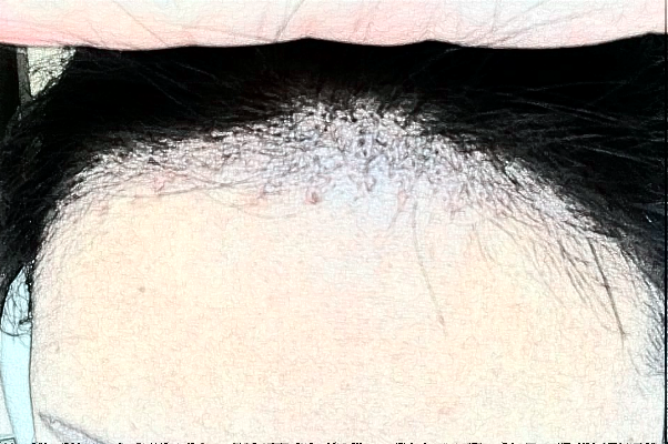 　　發(fā)際線不好看、大量脫發(fā)導(dǎo)致禿頂?shù)那闆r等，會給朋友們帶來很大的煩惱，這種情況可以選擇植發(fā)手術(shù)來，大連醫(yī)科大學(xué)附屬第一醫(yī)院做植發(fā)的技術(shù)比較不錯，根據(jù)大連地區(qū)網(wǎng)絡(luò)檢索的結(jié)果，比較常見的是發(fā)際線價格一般會在1100-38000元左右不等，比較常見的頭頂加密植發(fā)價格一般會在900-9300元左右不等，以上給出的價格僅供于參考，具體詳細(xì)的價格還需要到醫(yī)院找醫(yī)生進(jìn)行面診之后來獲取。  　　1、2024大連醫(yī)科大學(xué)附屬第一醫(yī)院植發(fā)案例  　　很多年前自己一直脫頭發(fā)，其實這也屬于正常的反應(yīng)，因為頭發(fā)都會有一個新陳代謝，隨著時間的增加，自己的頭發(fā)脫的有點多，每一次洗頭發(fā)的時候都掉一大把，當(dāng)時也沒有太在意，一次無意間發(fā)現(xiàn)了自己頭頂?shù)念^發(fā)有一些稀少，這才意識到了脫發(fā)的嚴(yán)重性，所以想通過植發(fā)手術(shù)來，在家人的陪同下來到了大連醫(yī)科大學(xué)附屬第一醫(yī)院，跟醫(yī)生說明了自己掉發(fā)的情況，并且問了醫(yī)生能不能做植發(fā)手術(shù)，醫(yī)生采取診斷之后建議說可以做植發(fā)手術(shù)，所以配合了醫(yī)生的工作，整體手術(shù)操作大概用了不到三個小時左右的時間，術(shù)后就能夠看到一些植發(fā)的痕跡，在半個月之后直的頭發(fā)慢慢的長了出來，看到長出來的頭發(fā)自己的心情也愉悅了很多，終于不用擔(dān)心頭發(fā)稀少的問題帶來的困擾了。  　　2、2024大連醫(yī)科大學(xué)附屬第一醫(yī)院簡介  　　大連醫(yī)科大學(xué)附屬第一醫(yī)院整形美容科是一個集醫(yī)療、教學(xué)、科研、預(yù)防為一體的大型綜合性醫(yī)院，醫(yī)院包括有美容外科、整形外科、頜面美容外科、皮膚激光美容外科等，醫(yī)院開展的手術(shù)項目有先天性和創(chuàng)傷性的畸形修復(fù)、除皺、乳房整形、減肥、面部年輕化抗衰老、植發(fā)、手術(shù)、手術(shù)等多個項目，醫(yī)院多年的發(fā)展結(jié)合了先進(jìn)的技術(shù)和設(shè)備儀器，建立了一個重大特色的項目合作單位，并定期會派專業(yè)的醫(yī)護(hù)人員進(jìn)行整形美容技術(shù)學(xué)術(shù)交流和研討，為廣大女性朋友在求美的道路上制定個性化的醫(yī)美服務(wù)，醫(yī)院內(nèi)的醫(yī)生都有著先手的操作手法，組建了一支技術(shù)精湛的醫(yī)生團(tuán)隊，會為女性朋友在秋美的道路上所需求，進(jìn)行個性化的設(shè)計和診斷，得到了很多朋友們的一致好評。