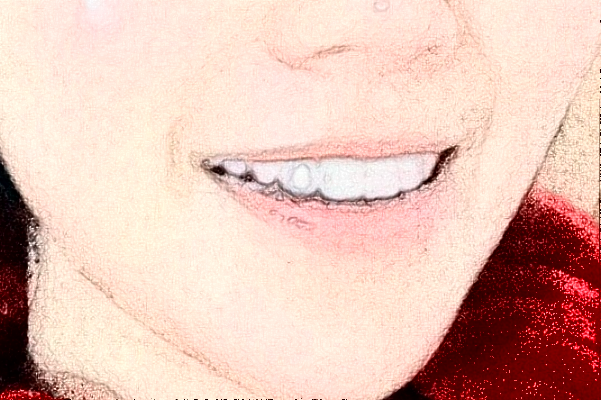 2024四川大學(xué)華西口腔醫(yī)院齙牙矯正怎么樣_哪個醫(yī)生做的不錯