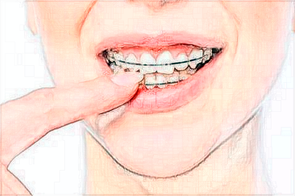 南昌大學第一附屬醫(yī)院打玻尿酸多少錢?玻尿酸墊下巴價格