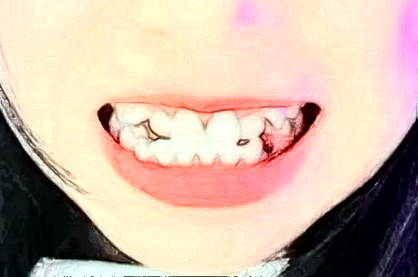 2024四川大學(xué)華西口腔醫(yī)院洗牙怎么樣_案例+價格展示