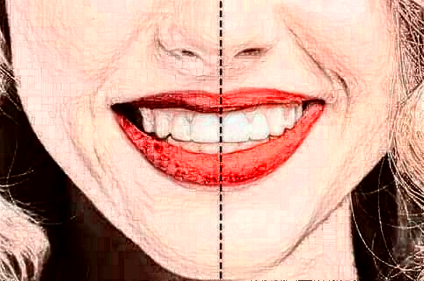 2024四川大學(xué)華西口腔醫(yī)院洗牙怎么樣_案例+價格展示