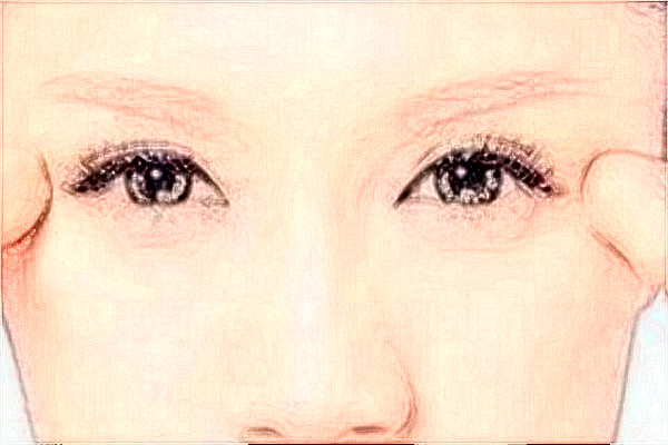 哈爾濱醫(yī)科大學附屬第一醫(yī)院光子嫩膚怎么樣【光子嫩膚案例】