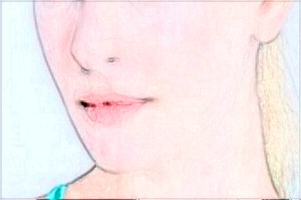 哈爾濱醫(yī)科大學附屬第一醫(yī)院光子嫩膚怎么樣【光子嫩膚案例】