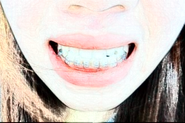 金華市中心醫(yī)院補(bǔ)牙做的咋樣_案例分享