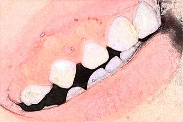 中山大學附屬第一醫(yī)院牙科哪個醫(yī)生好?牙齒矯正好嗎