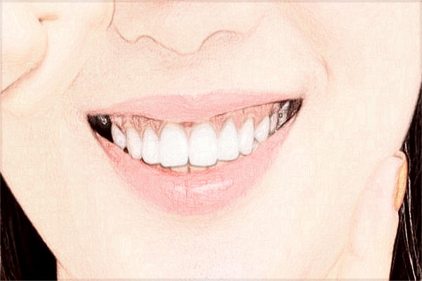 廣東省中醫(yī)院珠海醫(yī)院拔智齒價(jià)格表?拔智齒注意事項(xiàng)