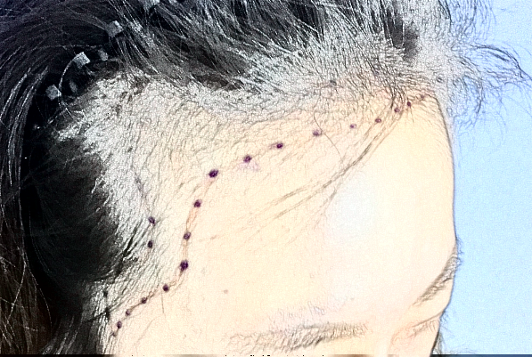 2024天津市第一中心醫(yī)院植發(fā)做的好嗎_醫(yī)生推薦