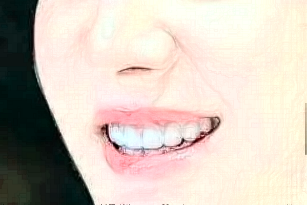 哈爾濱醫(yī)科大學(xué)附屬第一醫(yī)院補(bǔ)牙價(jià)格多少_做的怎么樣