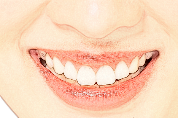 2024珠海市人民醫(yī)院種植牙價(jià)格?種植牙能維持幾年