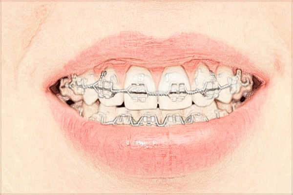 2024珠海市人民醫(yī)院牙科價目表?牙齒矯正多少錢