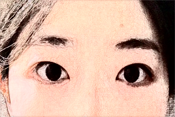 2024阜陽市人民醫(yī)院去眼袋怎么樣_案例分享