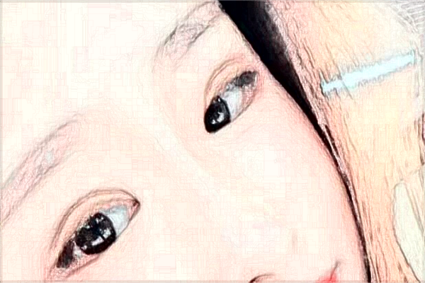 蘇州第四人民醫(yī)院激光去紅血絲多少費用？醫(yī)生排名