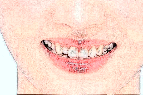 天津市口腔醫(yī)院牙冠哪個(gè)醫(yī)生好_專家案例